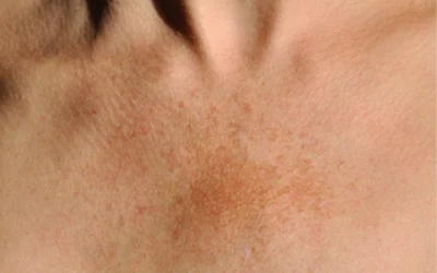 Seasonal Pigmentation and how to treat it properly