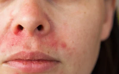 Perioral dermatitis: Why your skin might be reacting