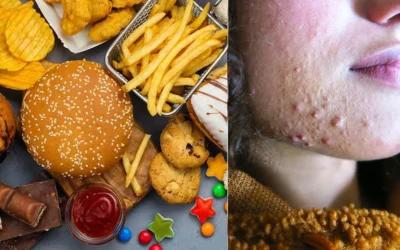 What to eat when you’re dealing with acne